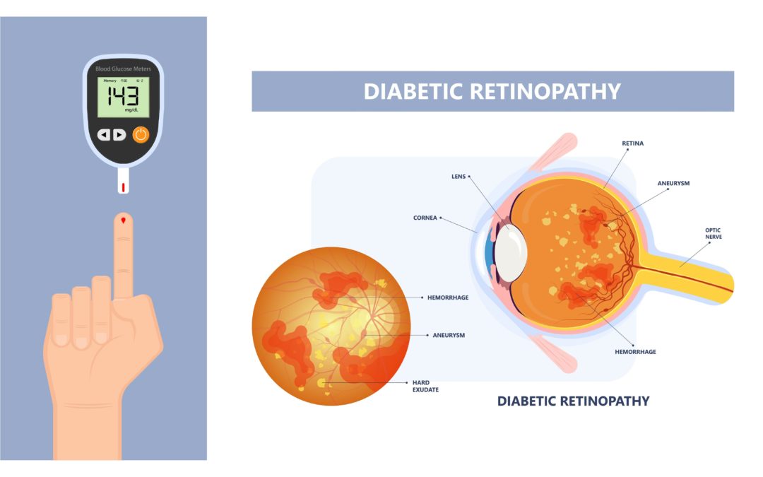 How Diabetes Can Affect Your Eye Health and Vision