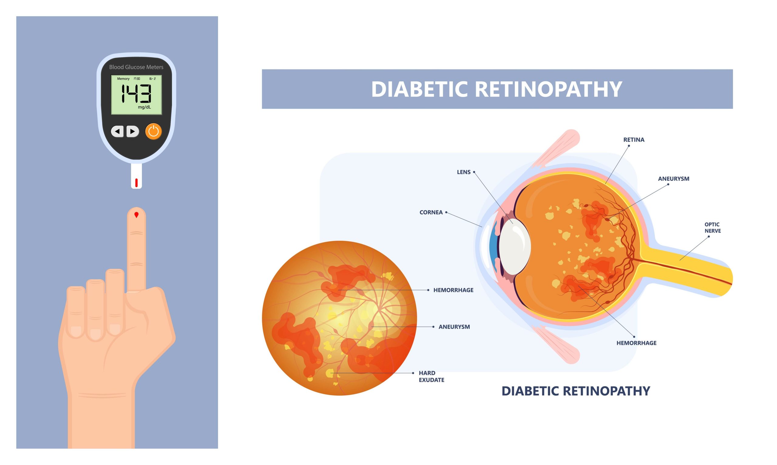 How Diabetes Can Affect Your Eye Health And Vision | Clarin Eye Care ...