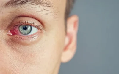 Sudden Eye Redness: When It’s Nothing vs. Something Serious 